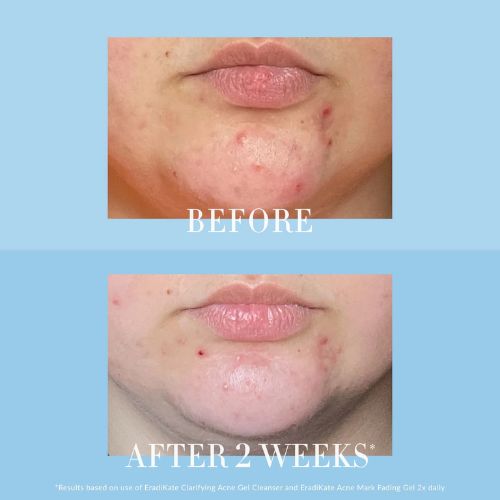 Final Sale! Kate Somerville Eradikate Acne Mark Fade Gel